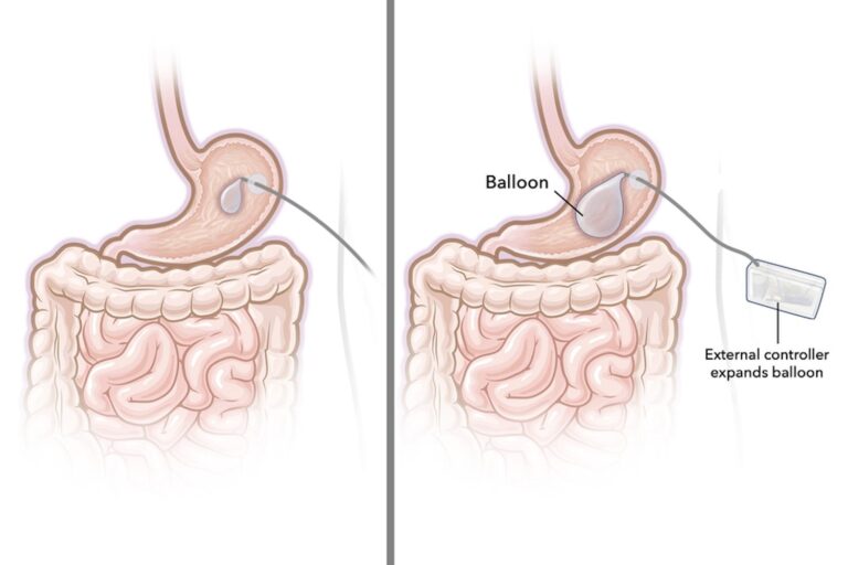 Ozempic Not Working for You? A Stomach Balloon Is the Latest Hope for Weight Loss