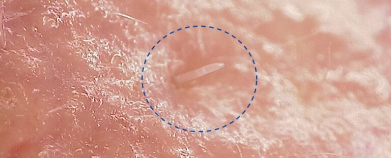 Skin Mites That Mate on Our Faces at Night Are Gradually Merging With Humans : ScienceAlert